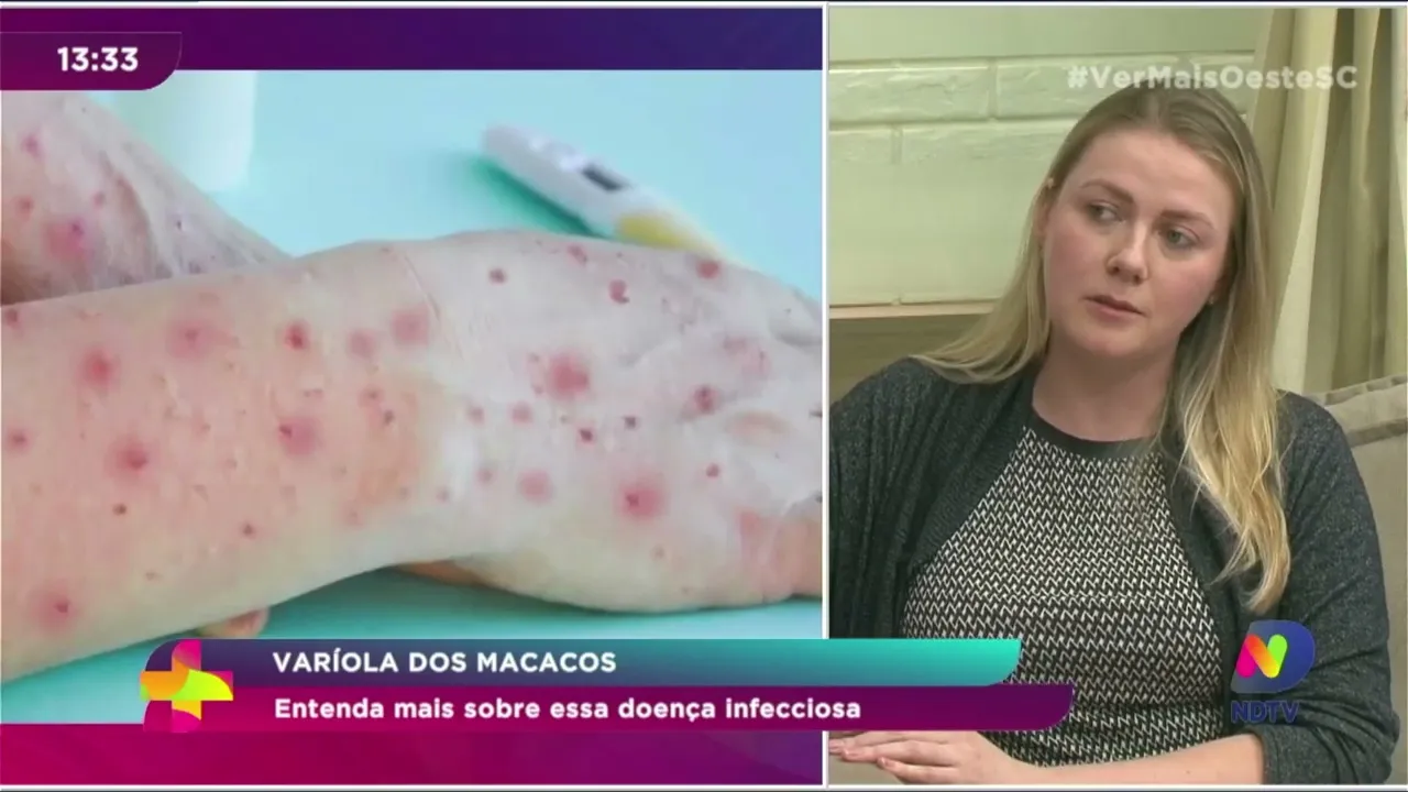 Varíola dos Macacos: entenda mais sobre essa doença infecciosa