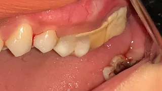 Heavy Tartar Removal.