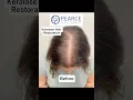 Download Lagu Keralase Hair Loss Treatments