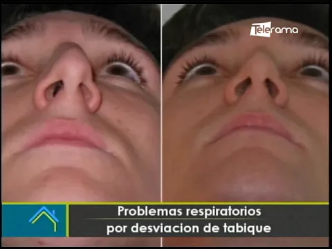 Problemas respiratorios por desviación de tabique