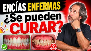 Como curar ENCÍAS ENFERMAS : Diferencia entre Gingivitis y Periodontitis. Síntomas y Tratamiento