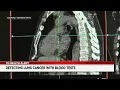 Cleveland Clinic experts explain how new blood tests can detect lung cancer