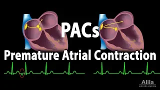 Premature Atrial Contractions PACs Animation