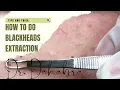 How To Do Blackhead Extraction Explained By Dr Dahabra Best Blackhead Extraction In Palm Beach