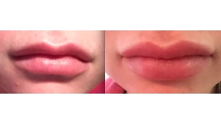 All About My Lip Injections