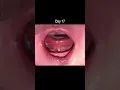 Download Lagu Tongue Tie Release - Healing Time Lapse