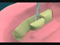 Dental for Tori Removal for Mandibular Denture - The tooth