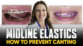 Midline Elastics and Canting