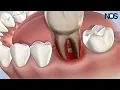 General Extractions at Naperville Oral Surgery Dental Implants