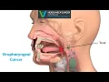 Oropharyngeal Cancer - What Is It Symptoms and Treatment Head and Neck Cancer