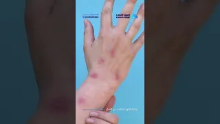 ظهور بقع حمراء على الجلد بشكل مفاجئ تعرفوا على اسباب ظهورها مع د أسامة القاضي استشاري الجلدية 