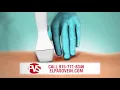 New Innovative Vein Treatment VenaSeal - at Physician s Vascular Services