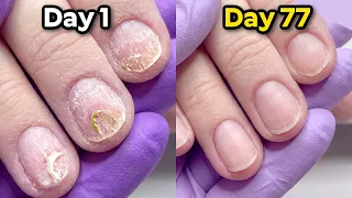 DIY Extensions Ruined Her Nails
