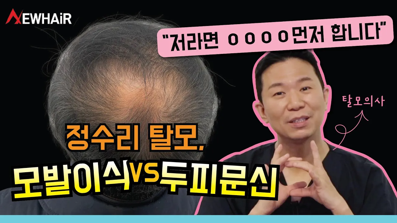 정수리모발이식 VS 두피문신 "저라면 이것 먼저 합니다"ㅣ뉴헤어