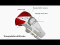 VY plasty for failed repair - short version