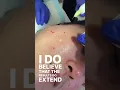 Download Lagu Rejuran S for Acne Scars | Dr Davin Lim