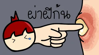 ประสบการณ์ ผ่าฝีก้น ครั้งแรกในชีวิต แบบไม่ได้เตรียมใจ...