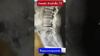  ทำไมการนั่งกับพื้นหรือก้มตัวถึงทำให้เจ็บหลังได้ในคนที่เคยผ่าตัดหลังมาก่อน 