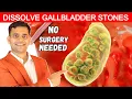 No Surgery Needed Dissolve Gallbladder Stone - Dr Vivek Joshi