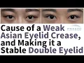 Cause of an Asian Double Eyelid Becoming a Monolid or Multiple Creases and How to Stabilize it
