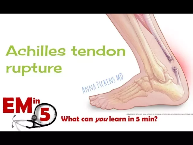 Achilles Tendon Rupture