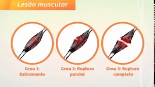 LESÃO MUSCULAR - LIGADO EM SAÚDE - CANAL SAÚDE