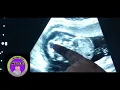 Grossly Abnormal Fetus Ultrasound lecture