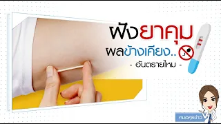 การคุมกำเนิดแบบฝังมีวิธีการทำงานอย่างไรบ้าง