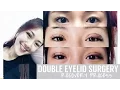 Non-Invasive Double Eyelid Procedure - Recovery Process FATFOAL