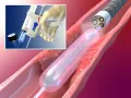 Download Lagu Balloon Endoscopy with the CRE™ Balloon Dilator