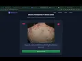 AI Skin Cancer Detection System Deep Learning Project Python