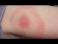 Health s Warn COVID-19 Lyme Disease Symptoms Similar