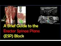 ESP Block - How To Perform It Effectively \u0026 Safely (2022)