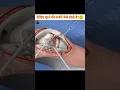 Download Lagu देखिए घुटने की सर्जरी कैसे होती हैं?🤔 || See how knee surgery is done. || #ashwanifactsworld #short