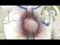 Download Lagu Commotio Cordis Explained Using 3D Animation