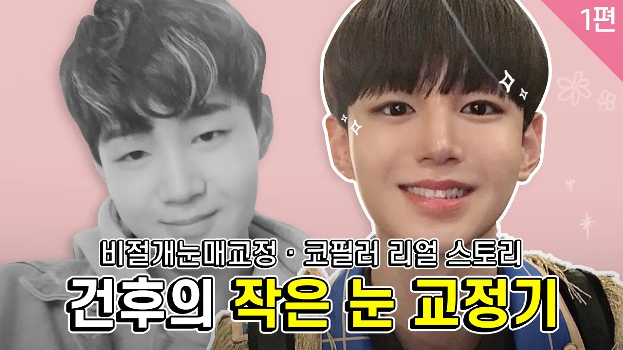 남자 눈 성형수술 안검하수 필러 /예비 유튜버 건후의 리얼스토리(비포영상)