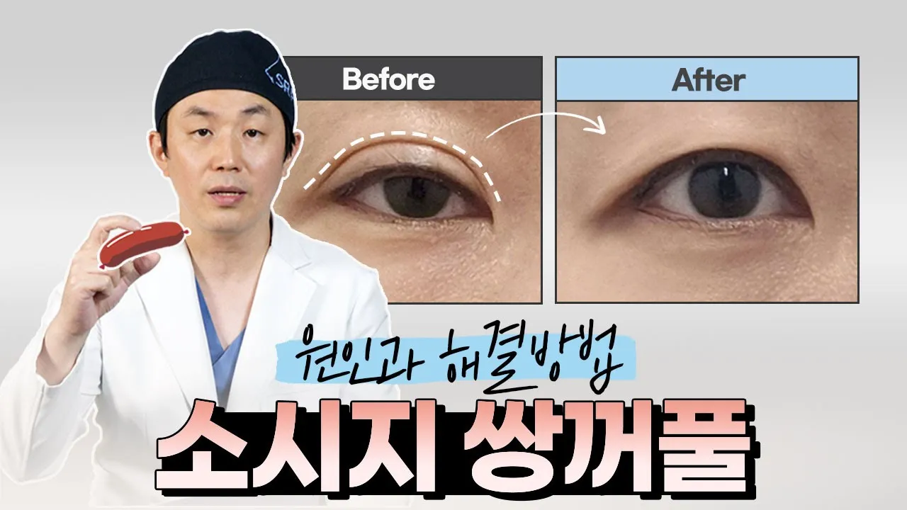👁‍🗨 쌍수 후 소시지 쌍꺼풀 되는 원인과 해결방법은? (한줄따기 vs 두줄따기 차이점)