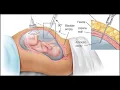 Fetal fluid drainage CPT code - simplify medical coding