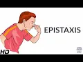 Epistaxis Causes SIgns and Symptoms Diagnosis and Treatment