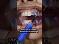 Invisalign attachments
