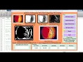 Matlab Code for Diabetic Retinopathy Detection Using Image Processing Full Source Code