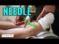 Scared of Needles Watch a First Acupuncture Session