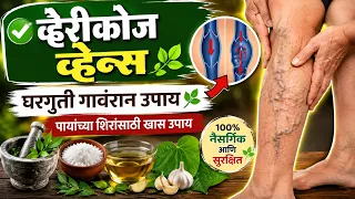 व्हेरीकोज व्हेन्सघरगुती गावंरान उपाय 🌿पायांच्या शिरांसाठी खास उपाय gharguti upay ✨