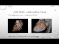 12 Lead ECG Episode 7 High Lateral STEMI