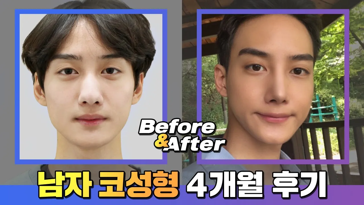 보정없는 남자코성형 후기)코성형4개월 후기_남자코성형으로 존잘남 인생 시작됐다