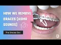 Download Lagu Satisfying Braces Removal w/ The Braces Doc (ASMR) — How we remove braces