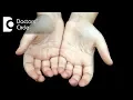 What causes palm skin to become hard its treatment - Dr Sachith Abraham