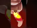 How Appendicitis Happens appendix symptoms - creativelearning3d