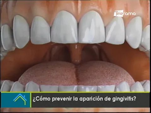 ¿Cómo prevenir la aparición de gingivitis?