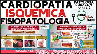 CARDIOPATÍA ISQUÉMICA FISIOPATOLOGÍA | GuiaMed
